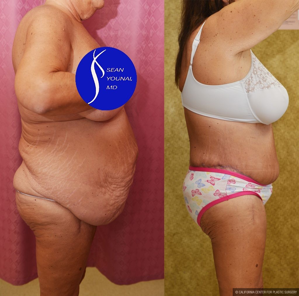 Body Lift Before & After Patient #14017