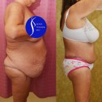 Body Lift Before & After Patient #14017