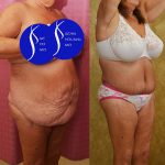 Body Lift Before & After Patient #14017