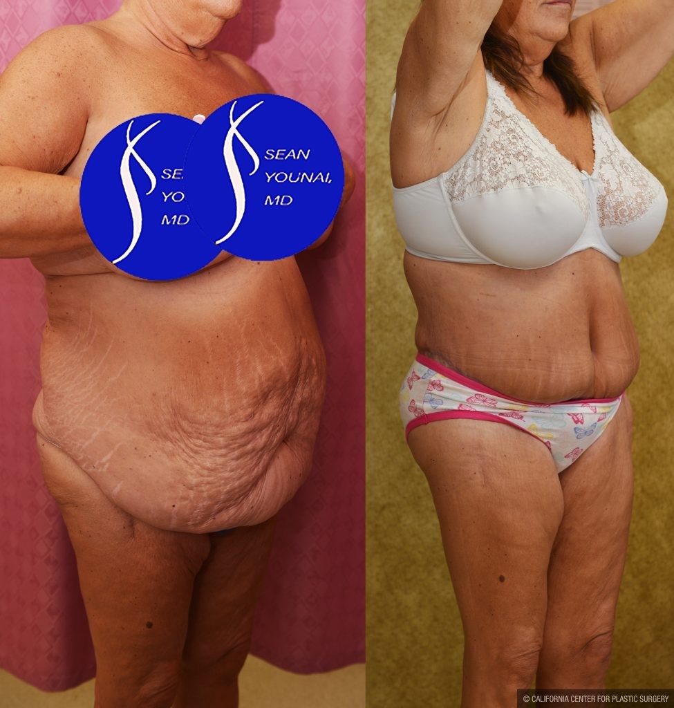 Body Lift Before & After Patient #14017