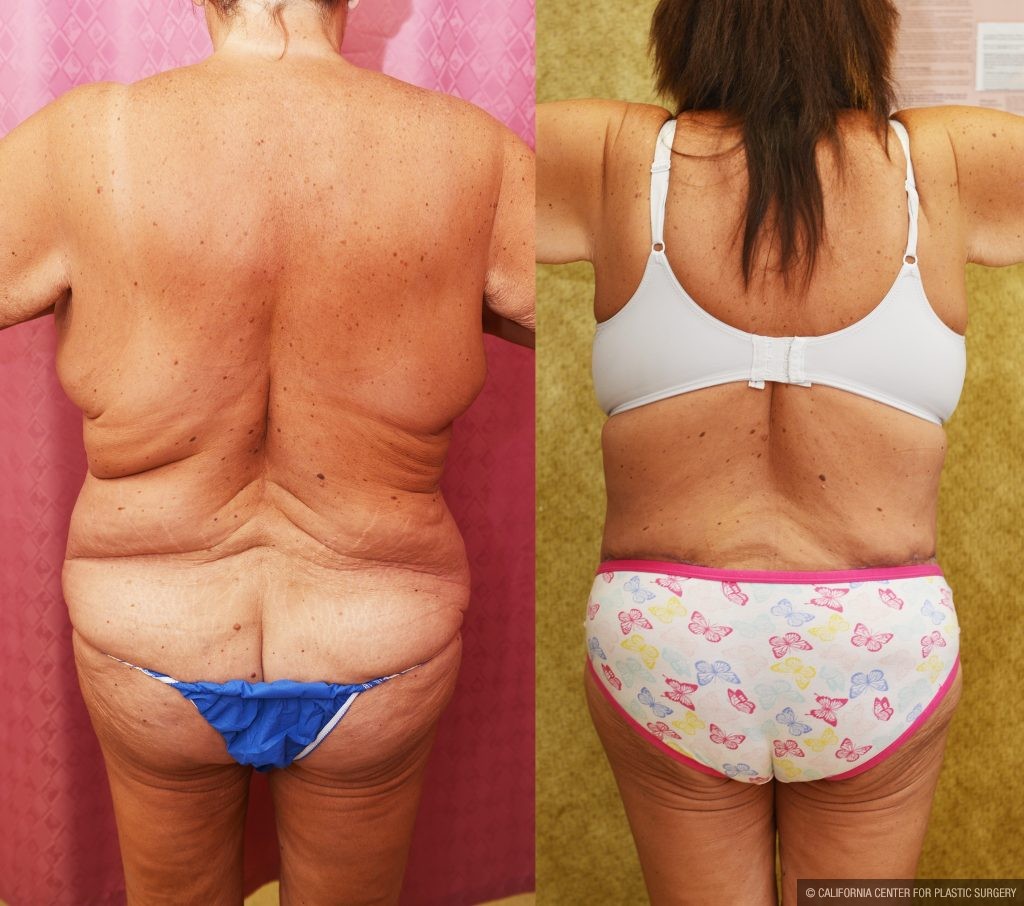 Body Lift Before & After Patient #14017
