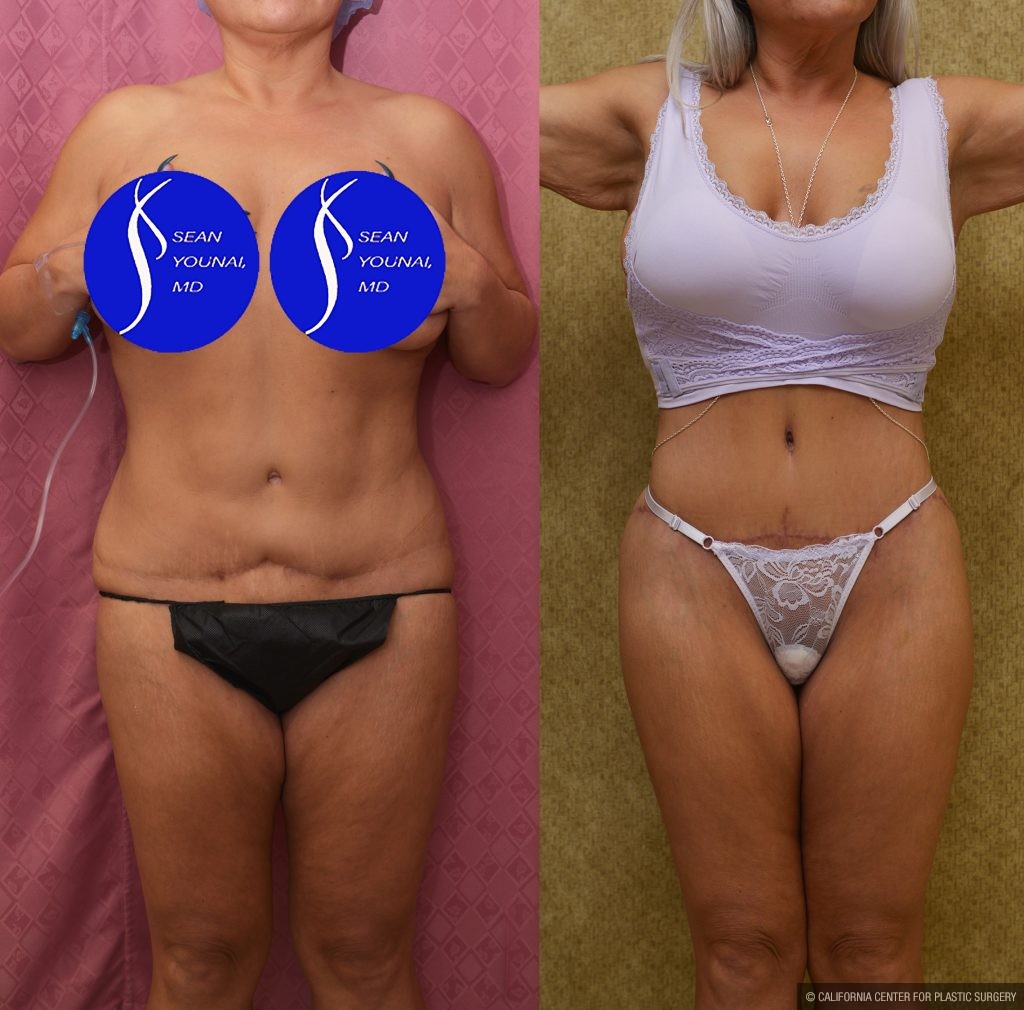 Tummy Tuck (Abdominoplasty) Revision Before & After Patient #14018