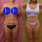 Tummy Tuck (Abdominoplasty) Revision Before & After Patient #14018