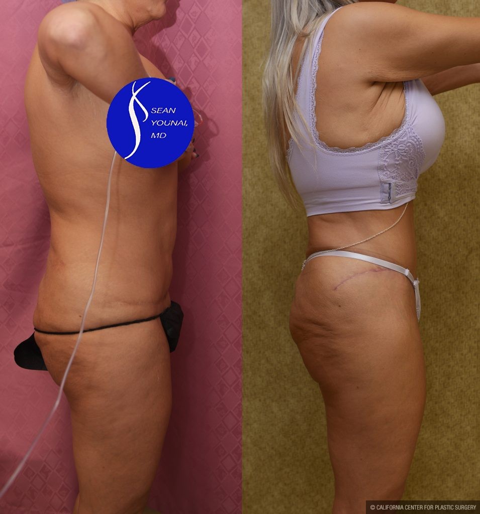 Tummy Tuck (Abdominoplasty) Revision Before & After Patient #14018