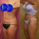 Tummy Tuck (Abdominoplasty) Revision Before & After Patient #14018