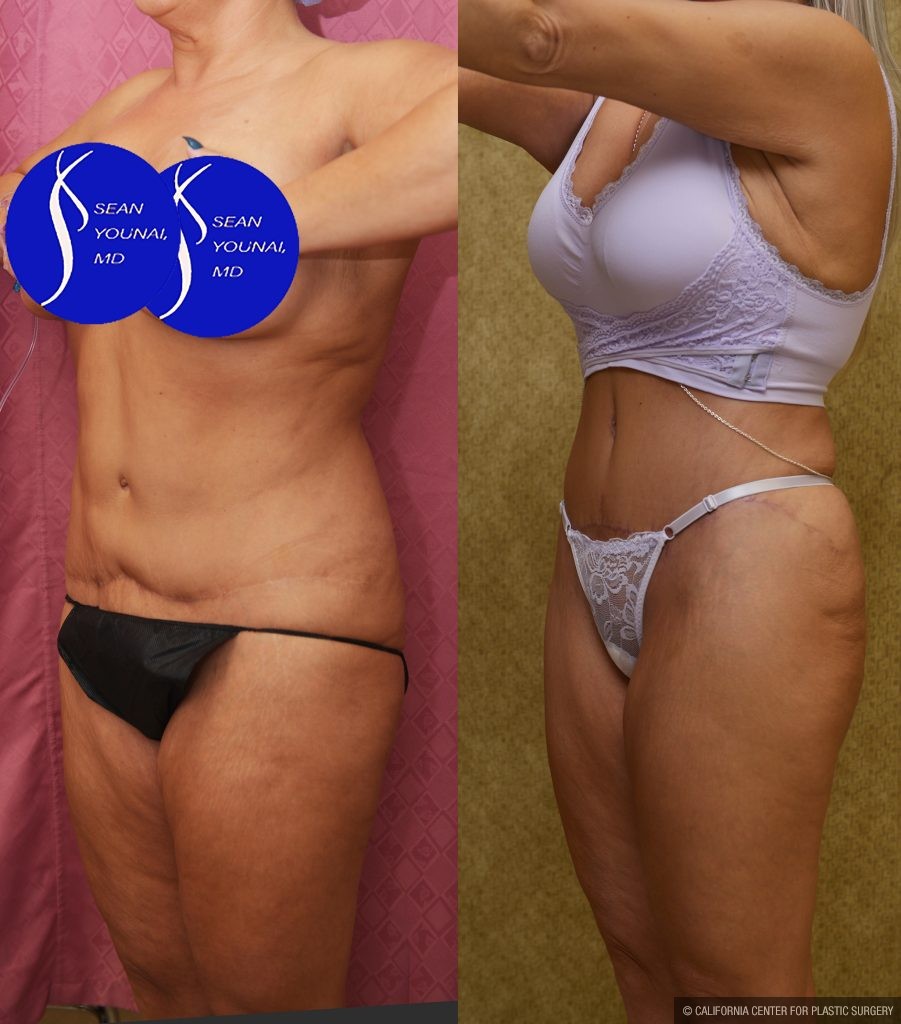 Tummy Tuck (Abdominoplasty) Revision Before & After Patient #14018