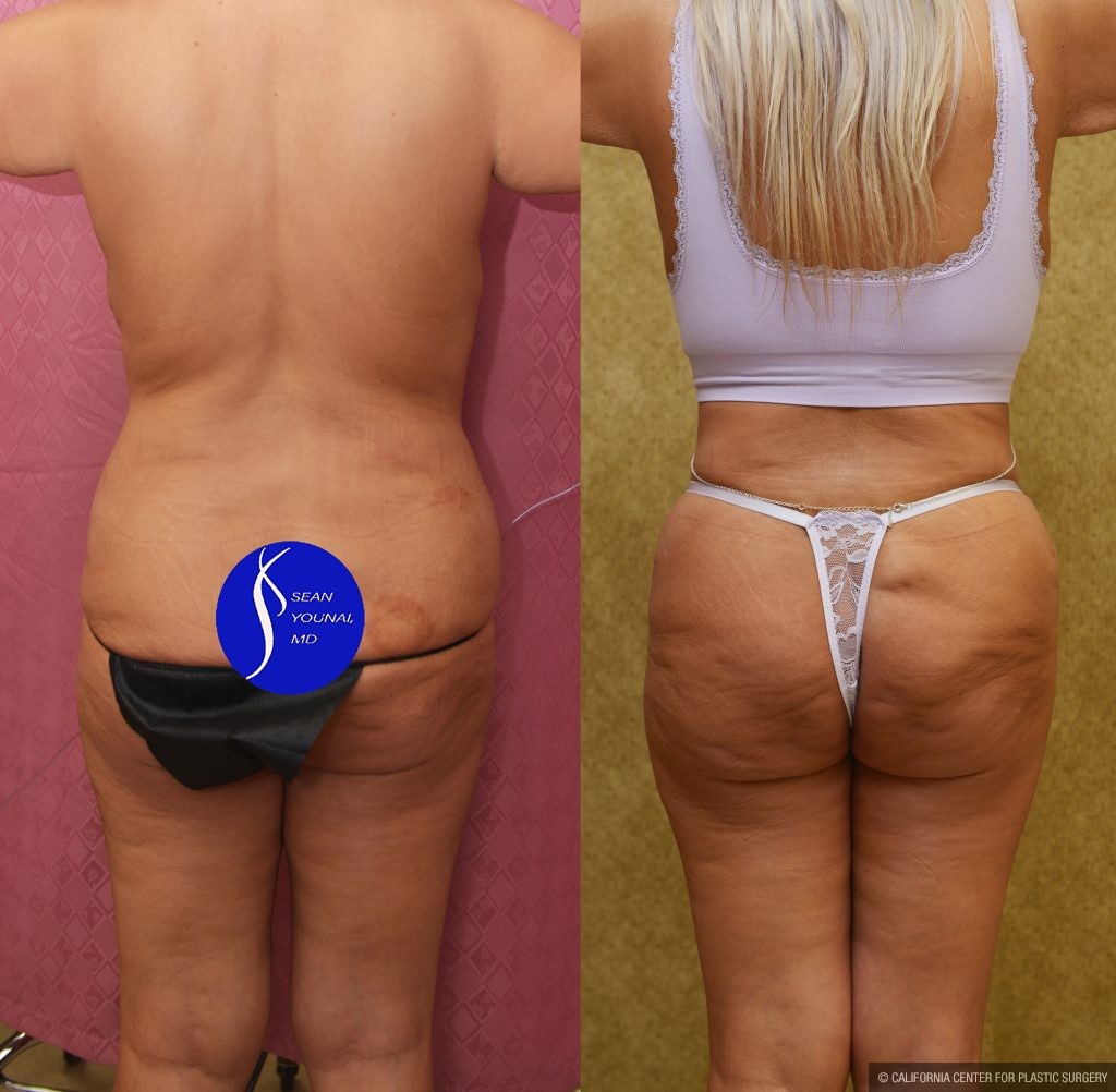 Tummy Tuck (Abdominoplasty) Revision Before & After Patient #14018