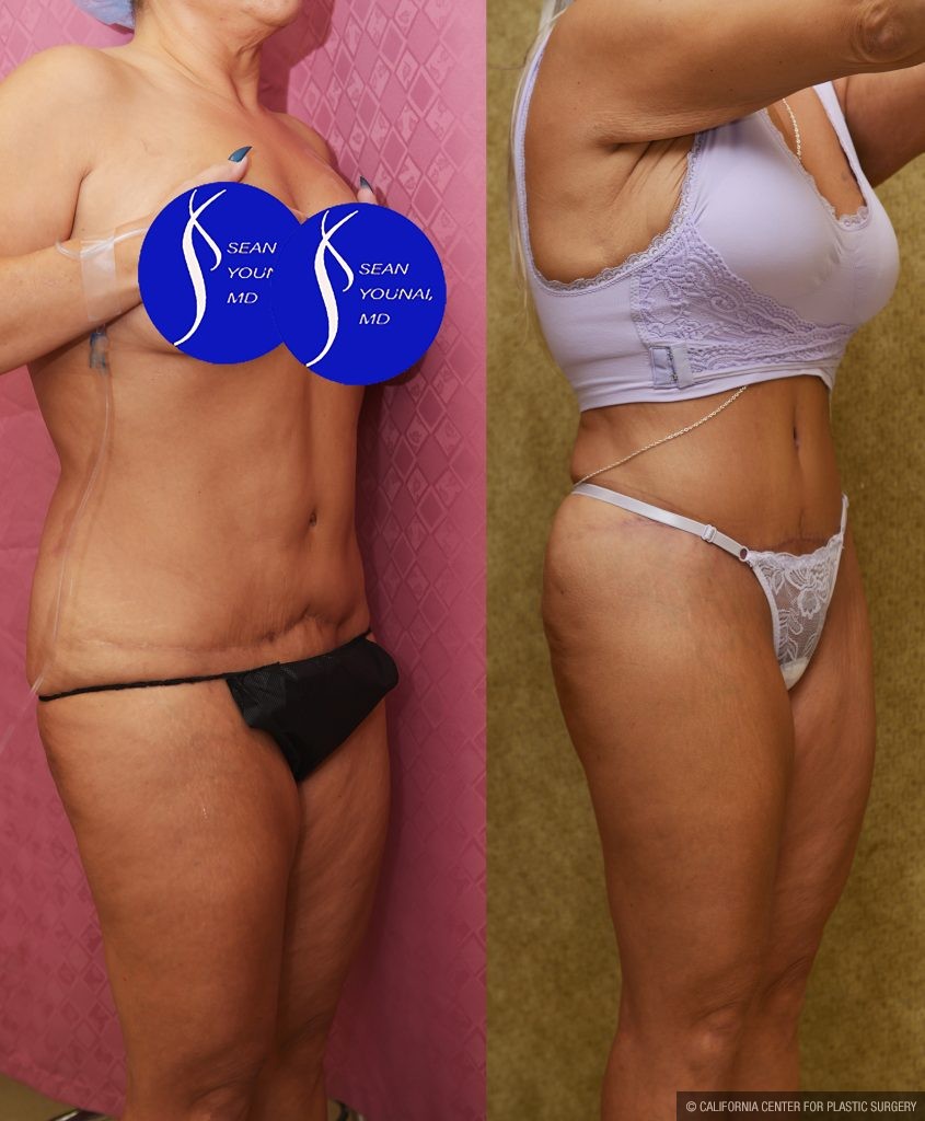 Tummy Tuck (Abdominoplasty) Revision Before & After Patient #14018