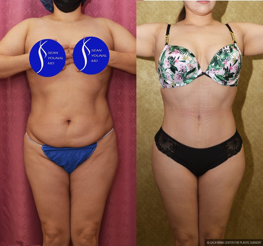 Tummy Tuck (Abdominoplasty) Small Size Before & After Patient #14019
