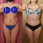 Tummy Tuck (Abdominoplasty) Small Size Before & After Patient #14019
