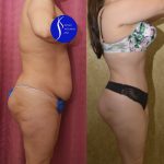 Tummy Tuck (Abdominoplasty) Small Size Before & After Patient #14019