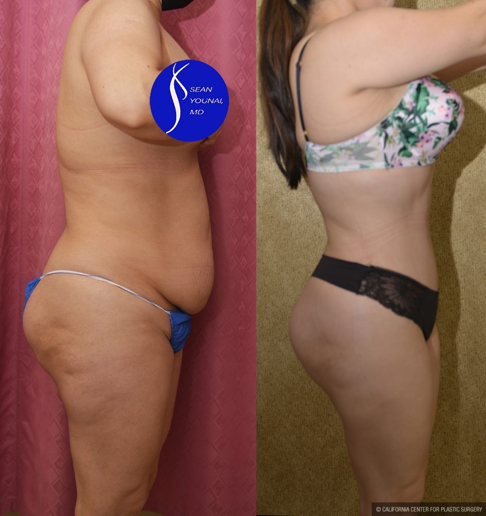 Tummy Tuck (Abdominoplasty) Small Size Before & After Patient #14019