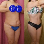 Tummy Tuck (Abdominoplasty) Small Size Before & After Patient #14019