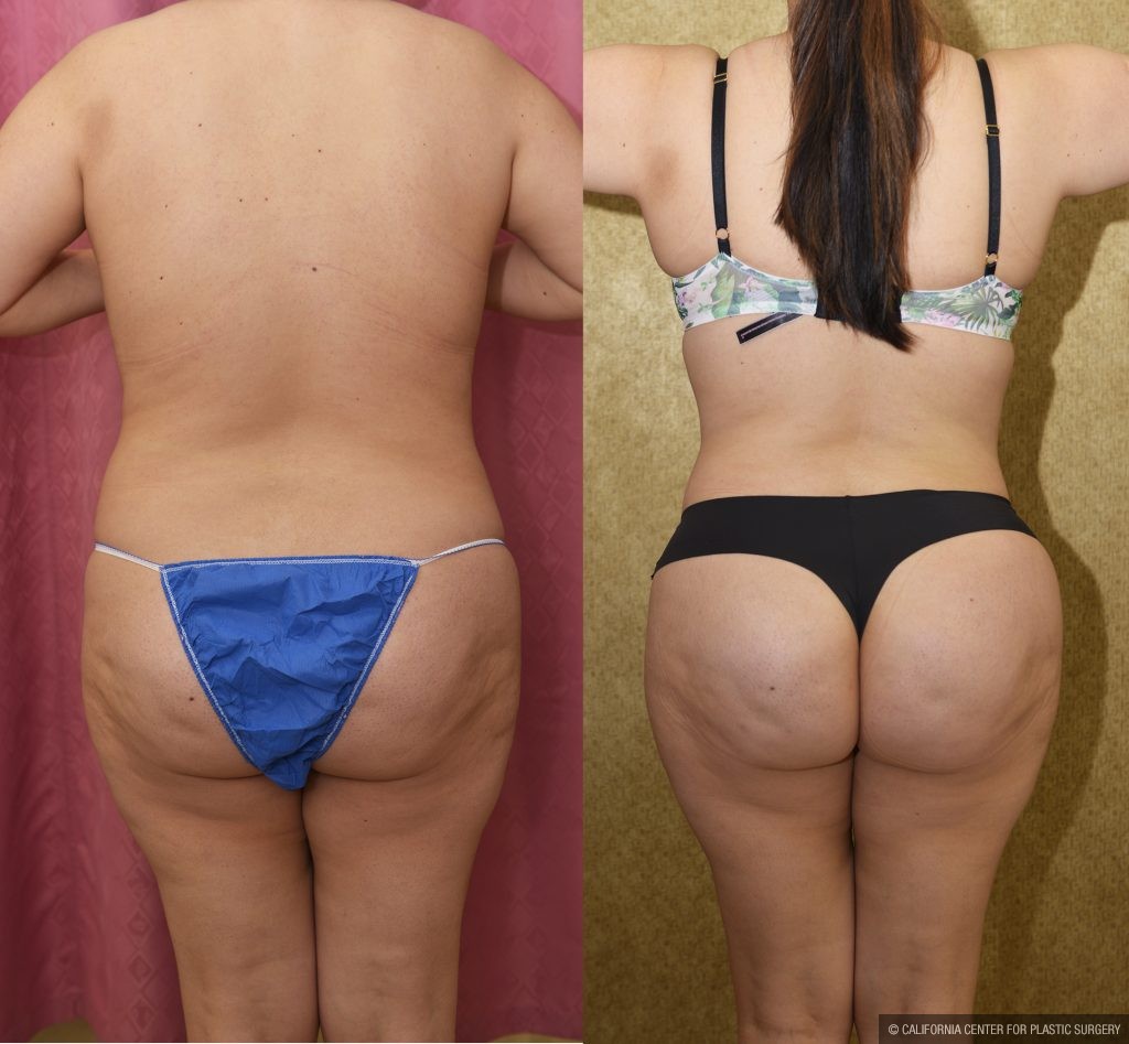 Tummy Tuck (Abdominoplasty) Small Size Before & After Patient #14019