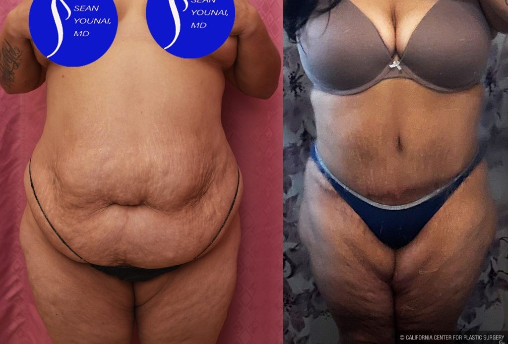 Tummy Tuck (Abdominoplasty) Super Plus Size Before & After Patient #14021