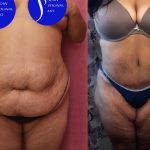 Tummy Tuck (Abdominoplasty) Super Plus Size Before & After Patient #14021