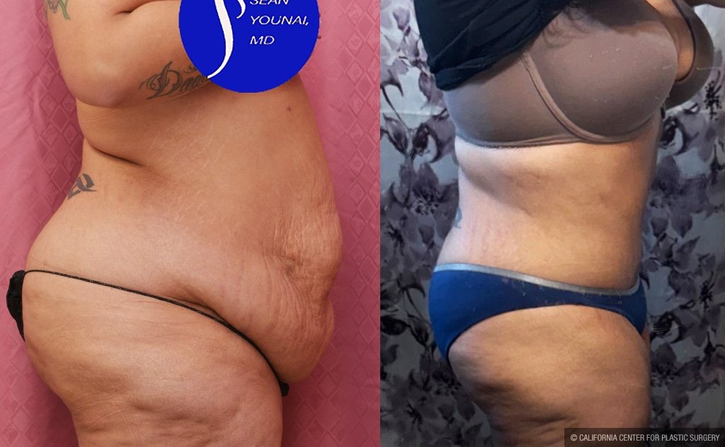 Tummy Tuck (Abdominoplasty) Super Plus Size Before & After Patient #14021