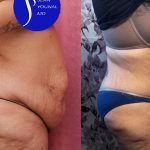 Tummy Tuck (Abdominoplasty) Super Plus Size Before & After Patient #14021