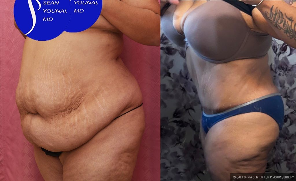 Tummy Tuck (Abdominoplasty) Super Plus Size Before & After Patient #14021