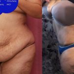 Tummy Tuck (Abdominoplasty) Super Plus Size Before & After Patient #14021