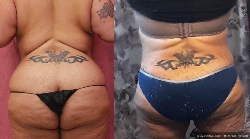 Tummy Tuck (Abdominoplasty) Super Plus Size Before & After Patient #14021