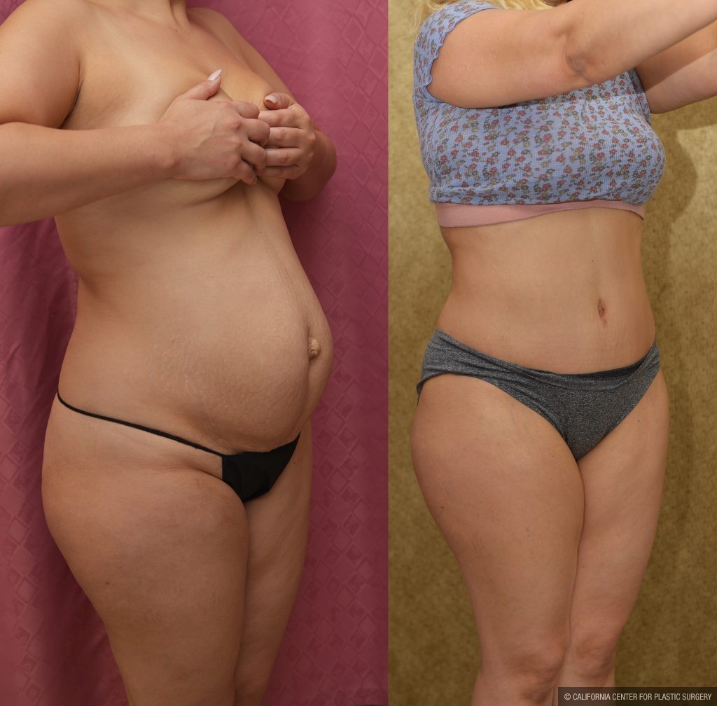 Tummy Tuck (Abdominoplasty) Small Size Before & After Patient #14020