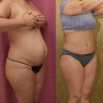 Tummy Tuck (Abdominoplasty) Small Size Before & After Patient #14020