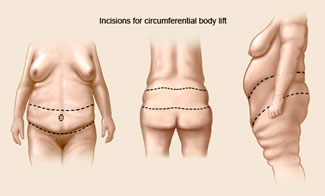 https://www.beautifulself.com/wp-content/uploads/sites/8/2013/10/incisions-circumferential-bodylift.jpg