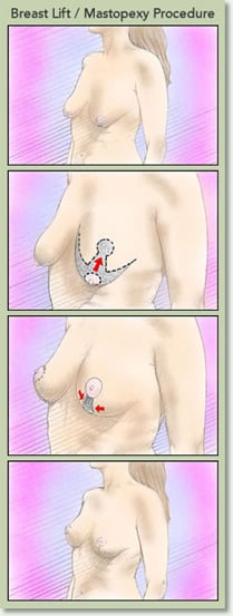 Breast Lift