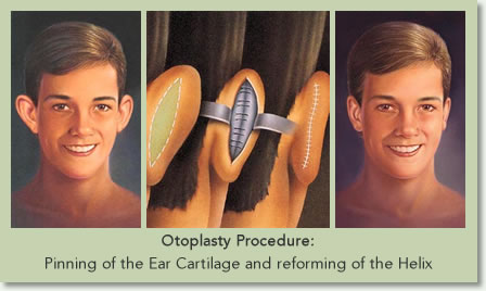 Otoplasty Beverly Hills