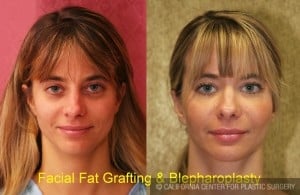 Lip Augmentation with Fat Grafting
